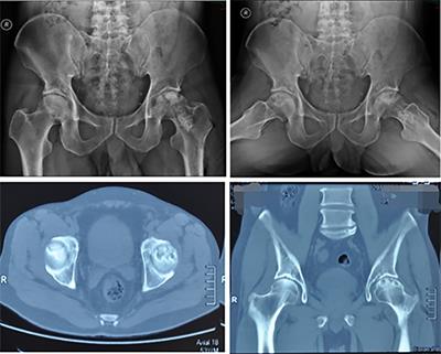 Femoral head metastases from primary mucinous lung adenocarcinoma with left hip pain: A case report and literature review